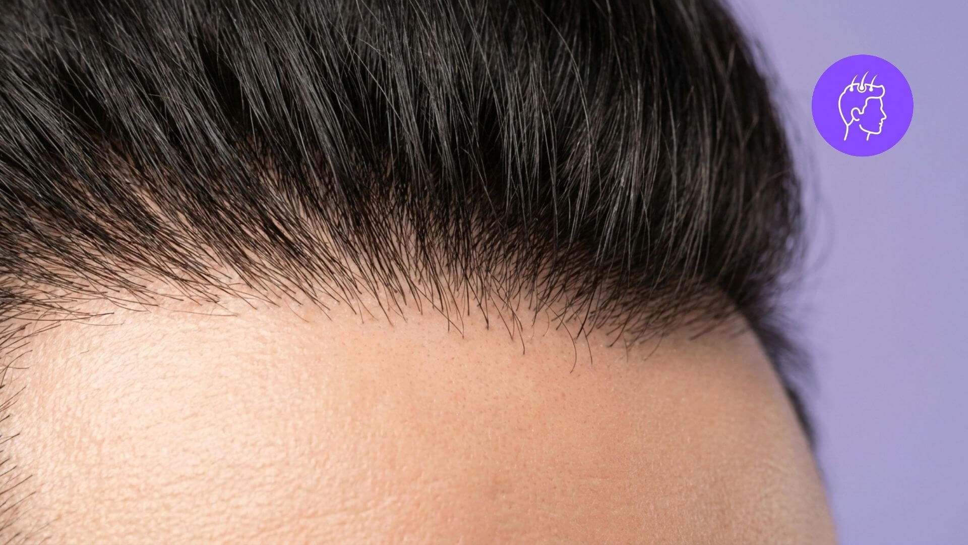 Hair Transplant